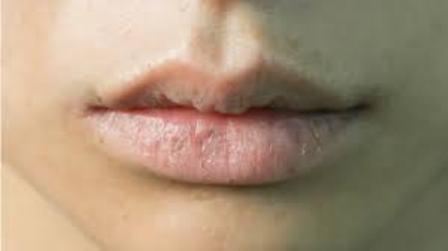 Tips Merawat Bibir Kering Saat Puasa