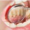 3 Bahan Alami untuk Bersihkan Karang Gigi, Ini Daftar dan Cara Gunakannya