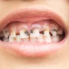 Simak! Cara Mengatasi Karies Gigi Pada Anak